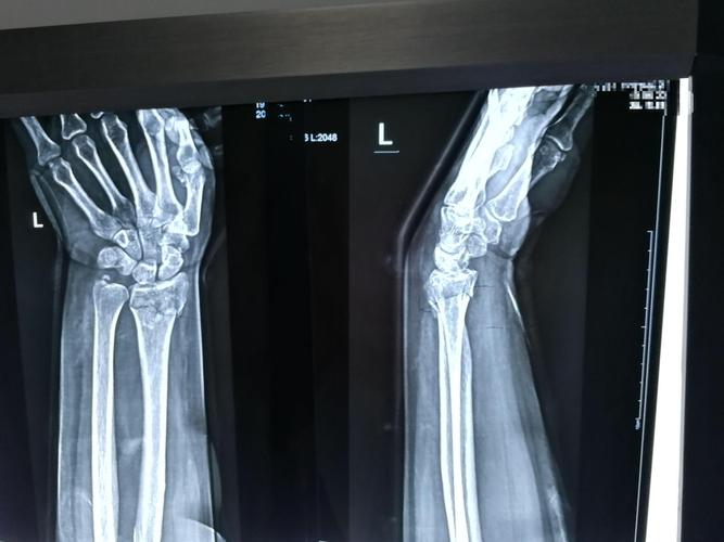 桡骨远端粉碎性骨折,一定要手术吗?