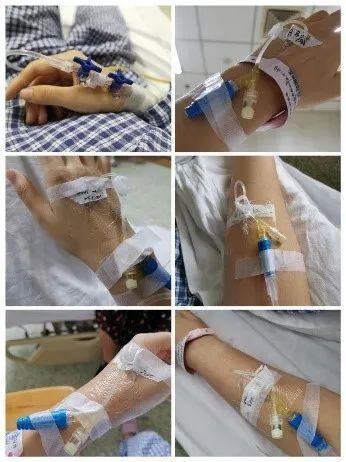 一天"吃掉"一根留置针 | 作者供图拔管,感觉身体被抽空带着引流管那