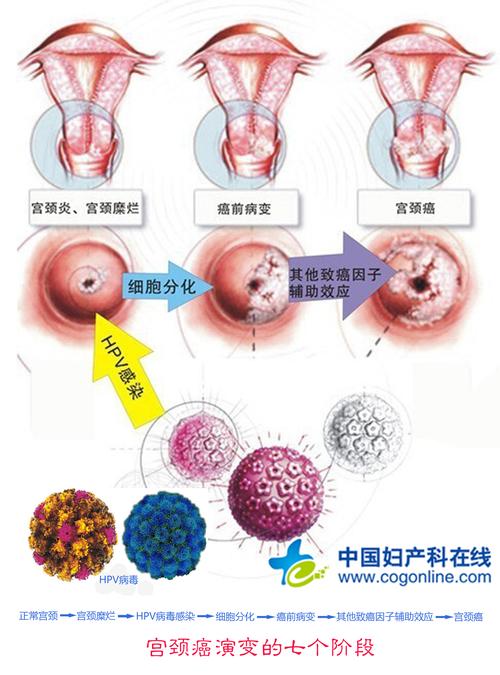 宫颈癌演变的七个阶段