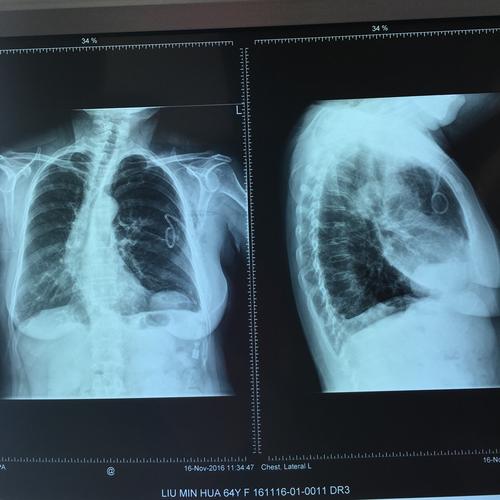 引流2天后无气体引流出,行胸片观察肺复张情况 鉴于患者气胸反复发作