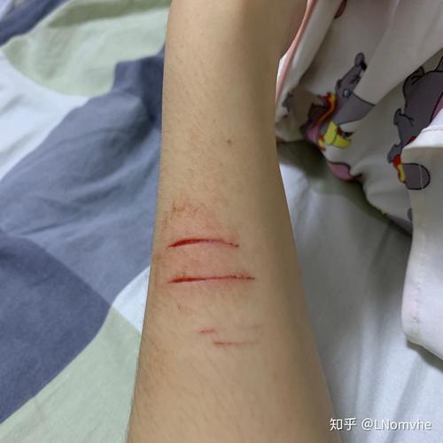 记录一下自己胳膊上的疤痕