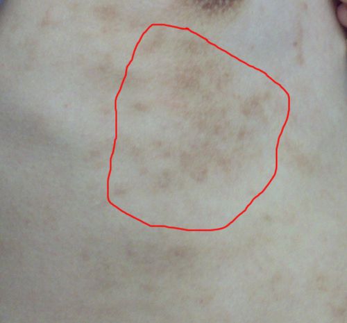 胸口下长的黑色斑点,不知道是什么?请懂皮肤的专家帮我看下!