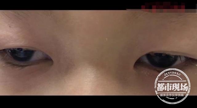眼睛奇痒!10岁女孩拔光睫毛,一个毛囊里竟有9只螨虫