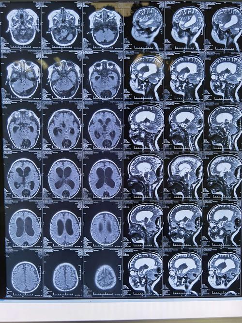 矢状位头颅核磁更清楚看到后颅凹结构下移,小脑和脑干贴合紧密,幕上脑