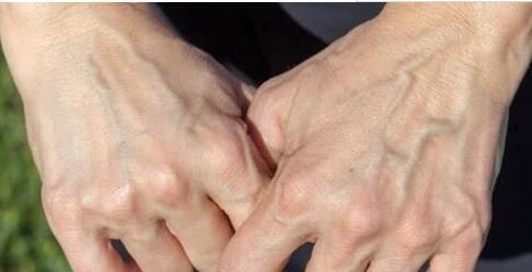 为什么手上青筋很明显手上青筋明显怎么回事