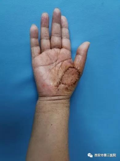 【伴你健康】手部血管瘤竟然恶变,险酿截肢大危害