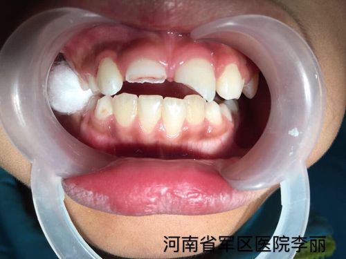 断裂的牙齿暴露了牙髓,让人看着很是心疼