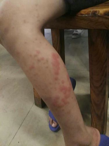 臭虫咬的,要去看什么医生或者吃什么药才会好