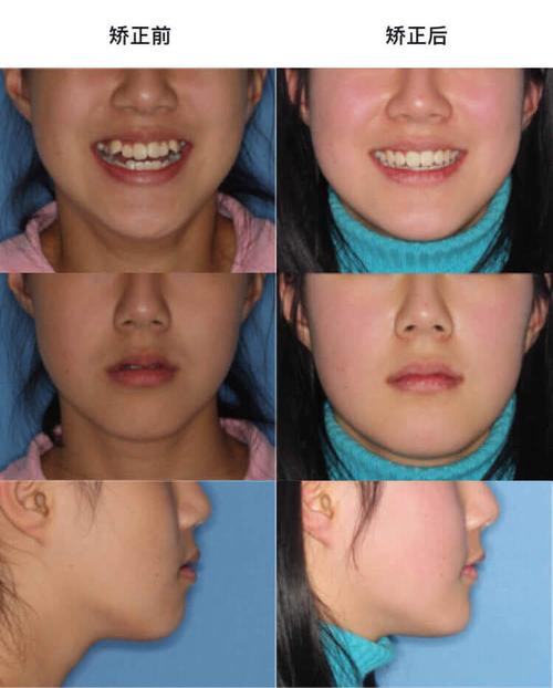 传统金属托槽拔牙矫正,解决牙齿拥挤