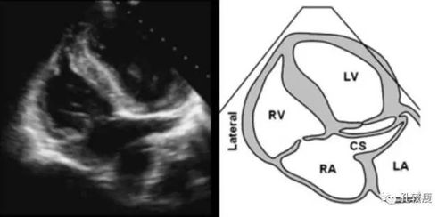 心尖五腔心切面:主要用于显示右心室侧壁及调节束▲胸骨旁四腔心