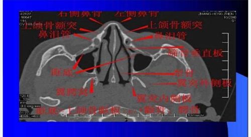 骨折,鼻窦炎,鼻息肉,内翻性乳头状瘤,鼻咽癌,腺样体肥大等,中耳乳突炎