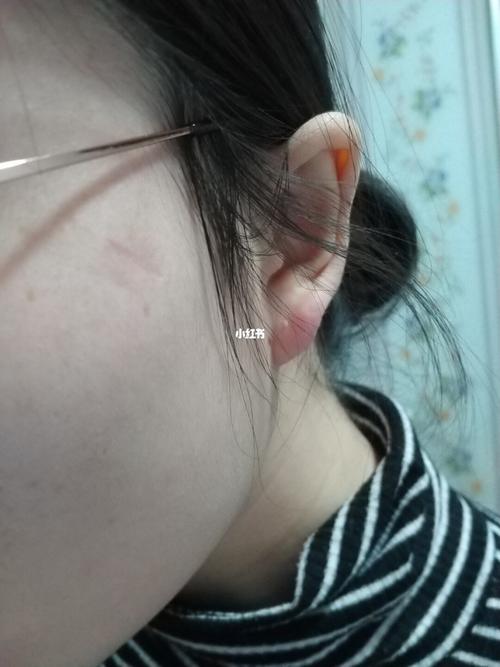 面部皮脂腺囊肿切除后的去疤之路