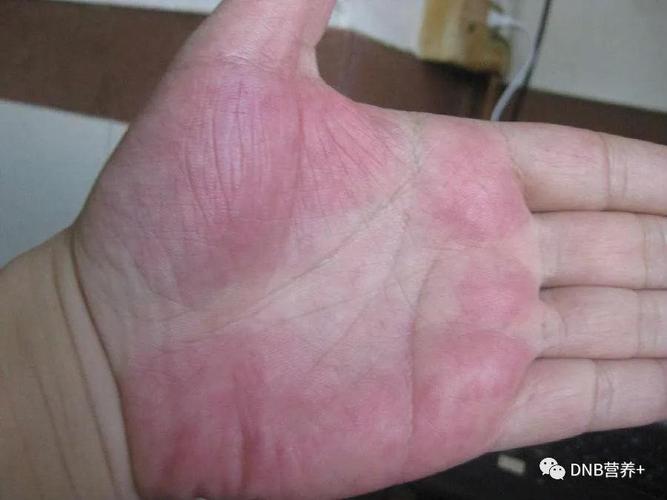 此外,皮肤科与瘙痒,红斑相关常见的有两大类疾病,其一是荨麻疹,其二