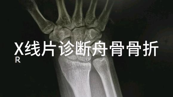 x线诊断舟骨骨折病例分享