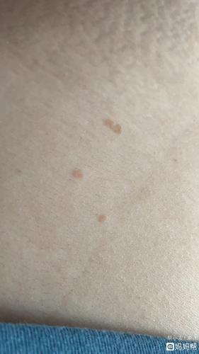 有谁怀孕后长这种褐色斑点的吗?