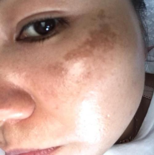 女人脸上长斑,生理和病理有什么区别?中医养颜,"血瘀"