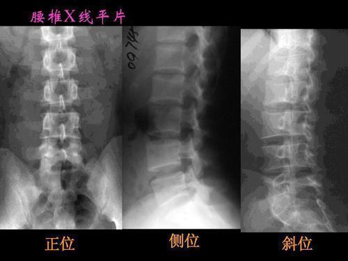 腰椎间盘突出检查就诊