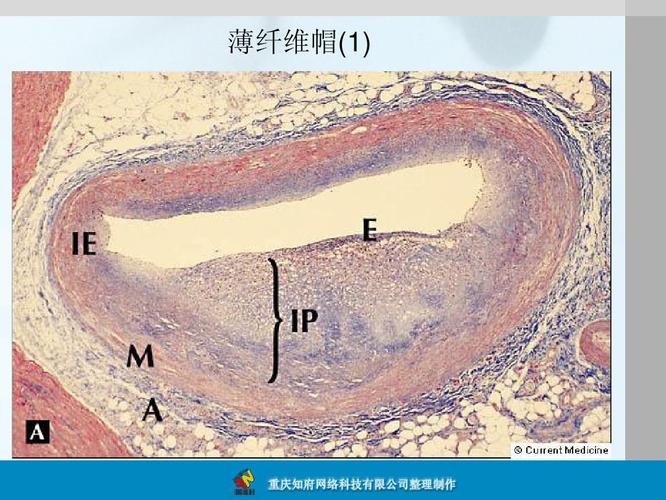 你可能喜欢 心血管系统课件 动脉粥样硬化的治疗 糖尿病诊治 冠状动脉