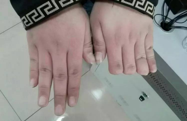 上图,虽然只有左手拇指末节残缺,但是不能申请所有车型.