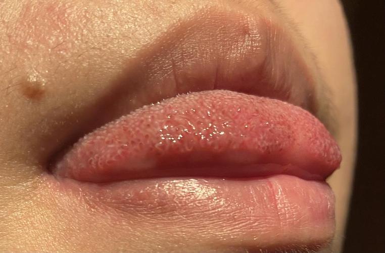 请问这个是口腔感染hpv的状态吗