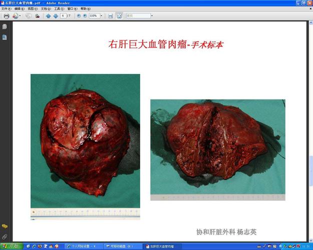 肝巨大血管肉瘤切除