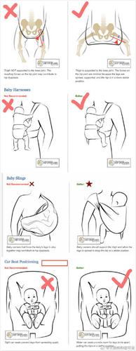 接到两位确诊髋关节发育不良的妈妈的留言,说骨科医生要求他们青蛙抱