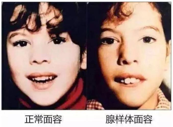 慢性鼻炎调理套餐