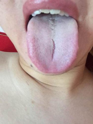 珍贵舌诊:肝郁气滞,阴虚火旺,脾胃虚寒的舌苔,看完记得存!