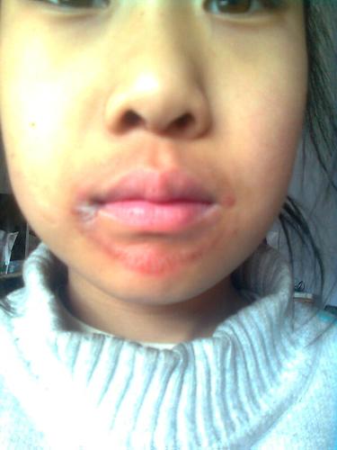 嘴唇下面一圈红,开裂