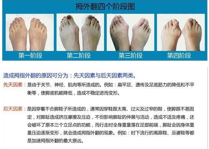 厂家批发脚拇指外翻矫正器脚趾矫正器脚趾分趾器大脚骨矫正器夜用