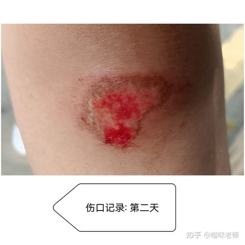 状态: 摔破皮的瞬间观察膝盖没有流血情况,视觉是券起了一层皮.