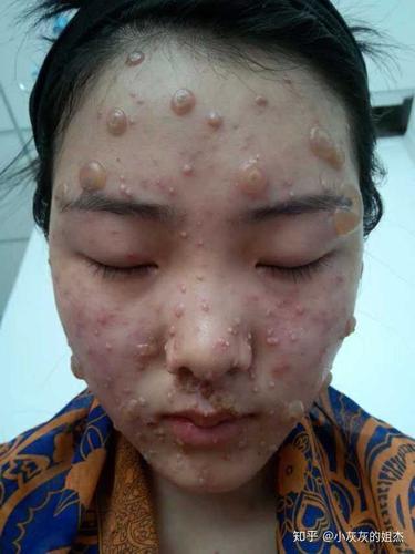 成人长水痘是什么样的经历?