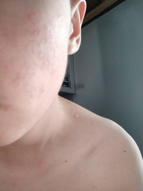 脸上长了好多红块块,摸上去跟藓一样毛毛的,很痒,面积