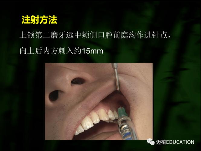 口腔局部麻醉技巧