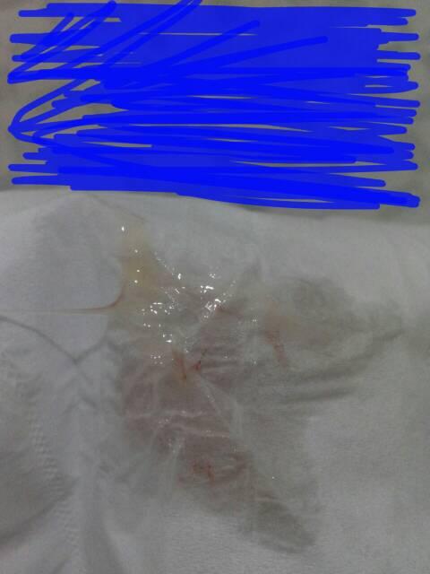 年龄24 ,白带异常有血丝(有图有点恶心慎点).1.25来的