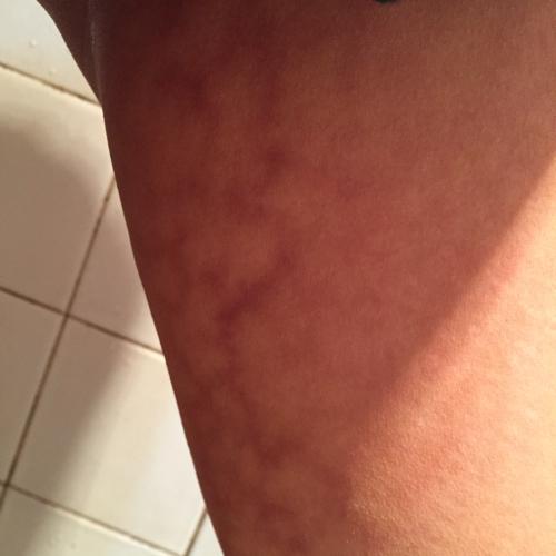 我大腿内侧的那一面的皮肤变成了网状一块一块的,看着