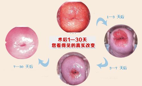 微创leep刀技术 治疗宫颈糜烂"金标准"