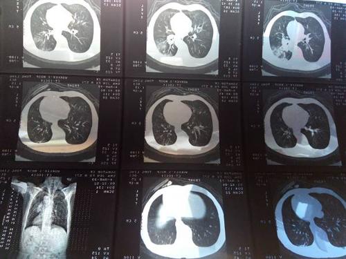 很多年前的片子了 我父亲的 想知道到底什么样的癌症 上几张ct图吧