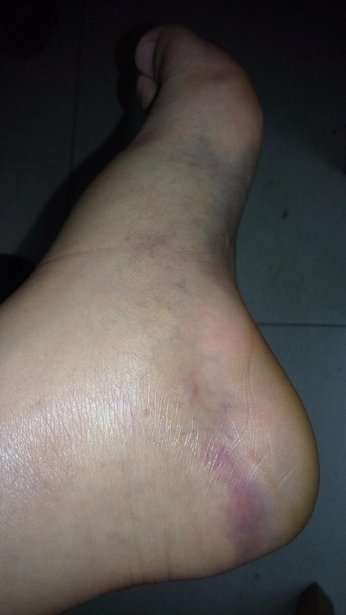 脚骨折到底多久可以走路