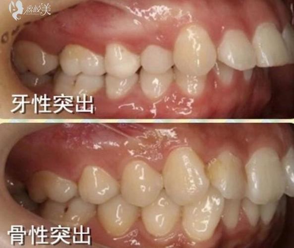 荔枝美:深圳吉华登特口腔门诊部牙性龅牙和骨性龅牙图
