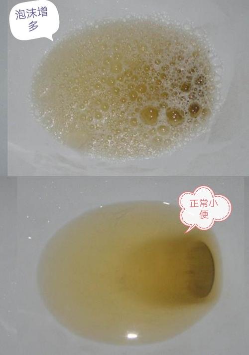 蛋白尿 - 好大夫在线