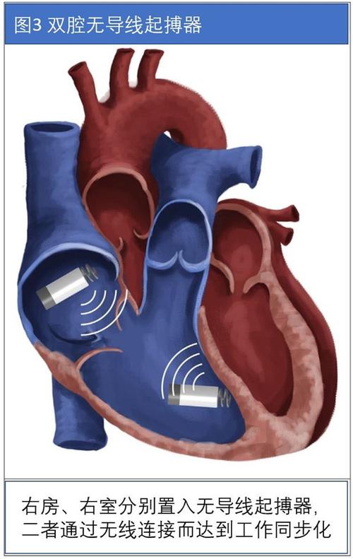 无导线起搏器的应用和进展