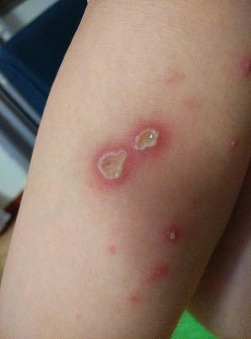 手臂是上表皮组织溃烂化脓(如图),是什么皮肤病啊,要用什么药