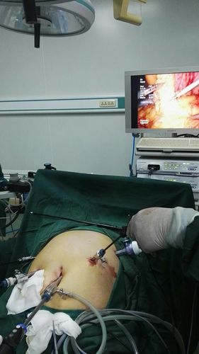 祝贺我院外科成功开展首例腹腔镜胃癌根治术