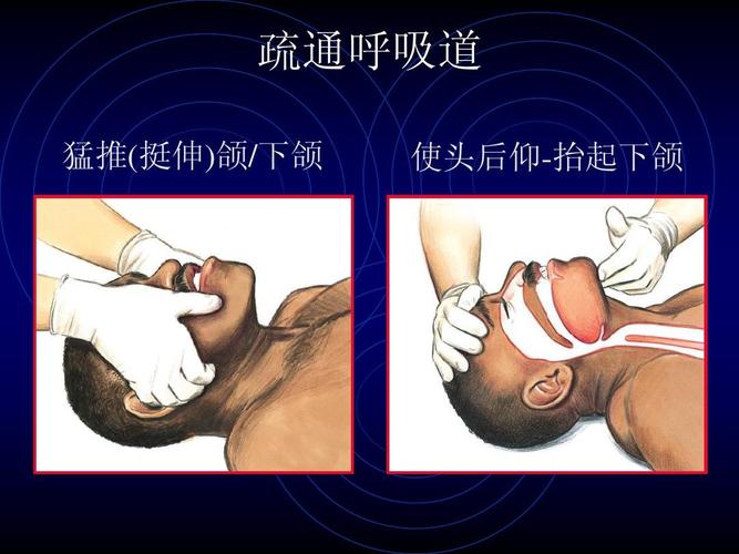 疏通呼吸道 猛推(挺伸)颌/下颌 使头后仰-抬起下颌