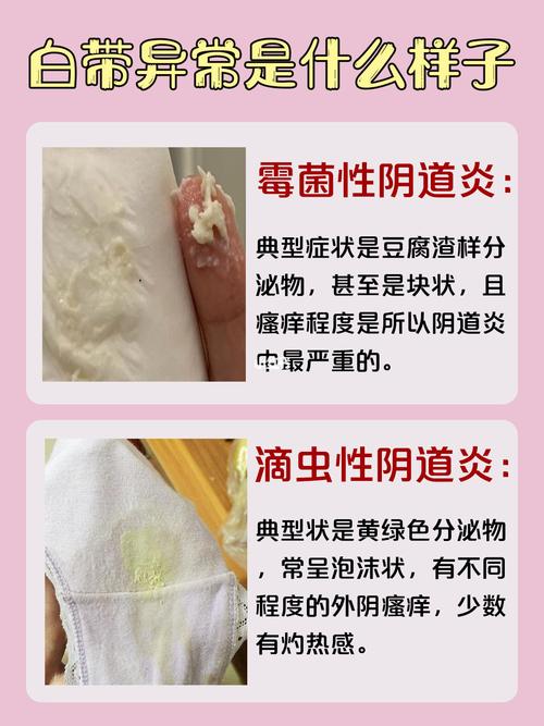 我的霉菌性阴焱时常反复一直都不好_内裤_洗衣机_妇科炎症_洗液