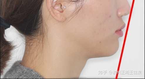 下颌后缩 侧脸看就相当明显