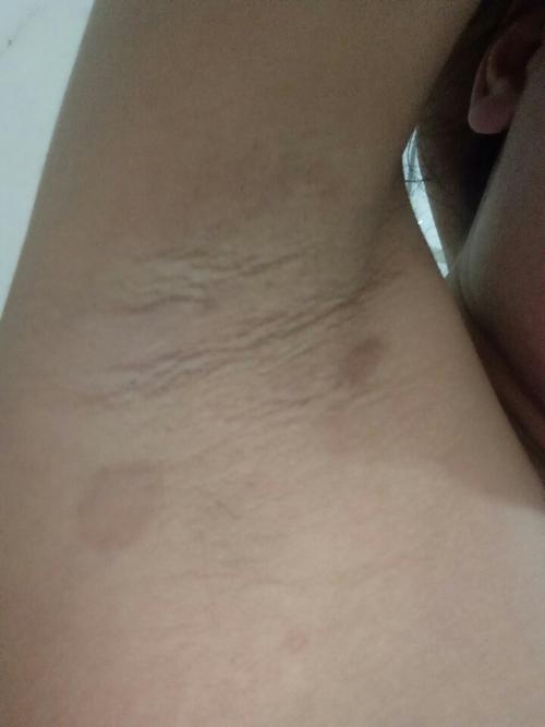 怀孕以后发现腋下.长了成这样,有谁知道在这是什么造成的