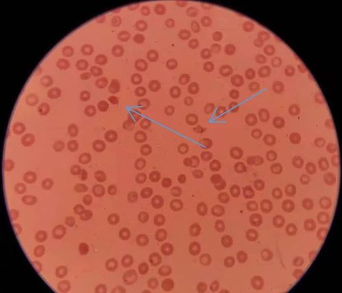 红细胞体积分布宽度rdw真的是可以忽视的指标么