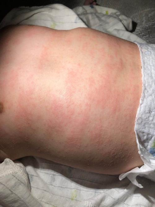 5个月大宝宝身上长满了红点,是什么?_母婴_育儿_母婴